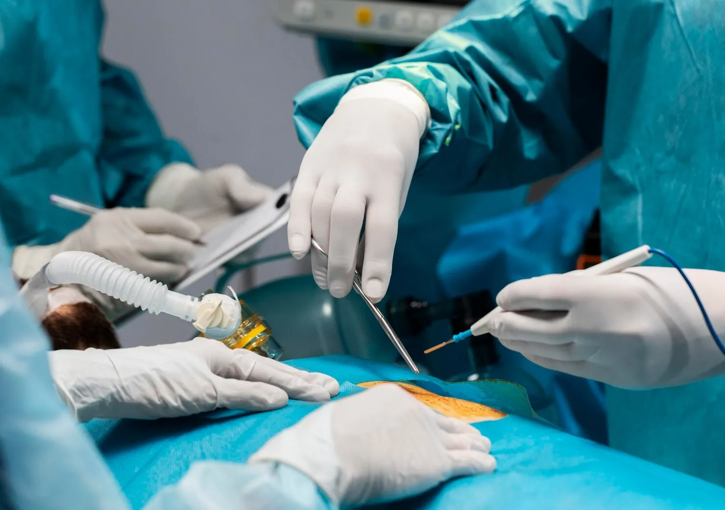 Laparoscopy